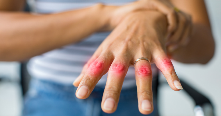 Mengenali Perubahan Sendi Sebagai Tanda Awal Artritis